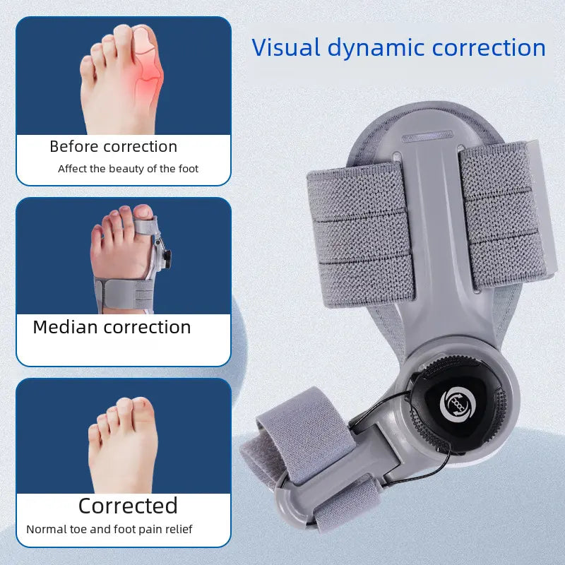 Upgraded Adjustable Bunion Corrector - Epic Deals USA
